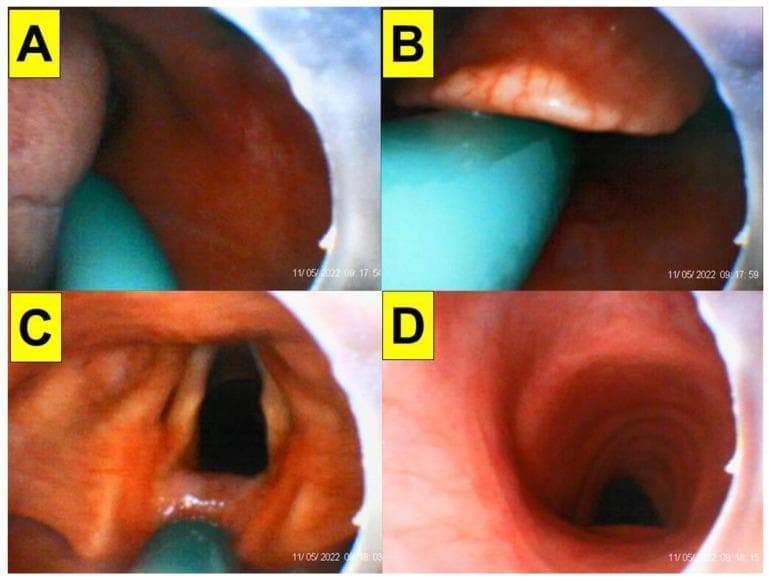 This endoscopic clinical image series consists of four panels (A-D) demonstrating the sequential progression of endotracheal intubation using a video-assisted intubating stylet. Panel A shows the initial entry into the oral space, with the tongue and posterior oropharyngeal mucosa visible alongside the teal-colored distal end of the intubating stylet. Panel B illustrates the visualization of the epiglottis, with the stylet positioned just inferior to it to facilitate lifting or bypassing the structure. Panel C provides a clear, 'full glottic' view, identifying key laryngeal landmarks including the vocal cords, arytenoid cartilages, and the glottic opening. Panel D captures the successful entry into the trachea, characterized by the distinct visual appearance of the tracheal rings (cartilaginous arches). The series serves as an educational tool for anesthesiology and emergency medicine, highlighting airway anatomy and the use of optical stylets in managing patients with potentially restricted neck mobility, such as those in stereotactic headframes.