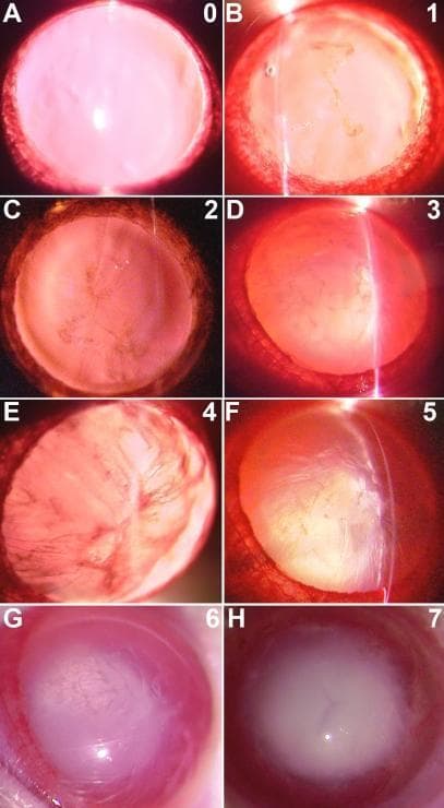 A series of eight clinical slit-lamp photographs (labeled A-H and graded 0-7) demonstrating the progression of cataract formation in a diabetic model, categorized according to the Oxford grading system. The images illustrate the transition from a clear lens (Grade 0) to total lenticular opacity (Grade 7). Key pathological landmarks include widening of the lens sutures (Grade 1), the emergence of radiating opacities from the sutures (Grade 2), and the development of a dense nucleus (Grade 3). More advanced stages demonstrate the formation of cortical clefts (Grades 4-5) and dense radial opacification (Grade 6). The final stage (Grade 7) depicts a mature, opaque nuclear cataract involving the entire lens volume. This comparison chart is used in ophthalmology to study the pathophysiology of diabetic cataracts and to evaluate the efficacy of therapeutic interventions on lens clarity. The visual sequence emphasizes diagnostic features such as nuclear density, suture morphology, and the structural integrity of the lens fibers.