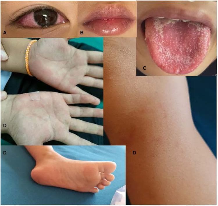 A composite of clinical photographs illustrating the classic mucocutaneous manifestations of Multisystem Inflammatory Syndrome in Children (MIS-C) and Kawasaki disease. Panel A shows bilateral non-exudative conjunctival injection, sparing the limbus. Panel B demonstrates erythematous, fissured, and swollen lips. Panel C displays a classic 'strawberry tongue' characterized by prominent lingual papillae and diffuse erythema with a patchy white coating. Panel D contains several images of the extremities, showing a faint, blanching maculopapular rash on the palms and soles, as well as an erythematous patch on the knee. These findings collectively represent systemic inflammation and vasculitis of the small and medium-sized vessels. The clinical significance of these visual signs is to aid in the prompt diagnosis of inflammatory syndromes following pediatric viral infections, specifically SARS-CoV-2. The target audience includes pediatricians and emergency medicine residents learning to recognize patterns of pediatric inflammatory conditions.