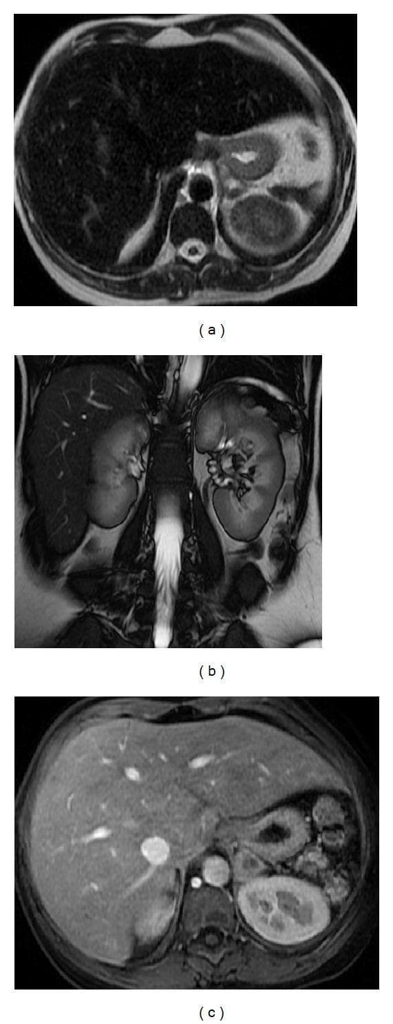 This diagnostic MRI series demonstrates findings consistent with autosplenectomy and secondary iron deposition in a patient with homozygous sickle cell disease. The image set includes: (a) an axial T2-weighted Single Shot Fast Spin Echo (SSFSE) image, (b) a coronal Steady-State Free Precession (SSFP) image, and (c) a post-contrast axial 3D-GRE T1-weighted image with fat suppression during the arterial phase. A key visual feature is the severe atrophy of the spleen, appearing as a small, retracted remnant in the left upper quadrant. Both the liver and the remnant spleen demonstrate diffusely diminished signal intensity (appearing dark/hypointense) across T1 and T2 sequences. This signal void is characteristic of significant iron deposition (hemosiderosis) resulting from chronic blood transfusions. The post-contrast arterial phase image (c) highlights the vascular structures with fat suppression, further emphasizing the hepatic parenchymal signal loss compared to normal tissues. This series illustrates the end-stage splenic complications of sickle cell disease and the multi-organ impact of iron overload.