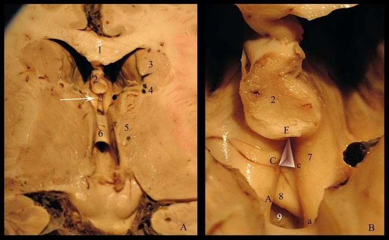 This composite of two clinical photographs displays a neuroanatomical dissection of the human brain, focusing on the roof of the third ventricle and the triangular recess. Image A provides a superior view of the ventricular space and surrounding landmarks, including the corpus callosum superiorly, the fornix, the caudate nucleus, and the thalamus lateral to the midline. An arrow highlights the triangular recess, showing its relation to the interthalamic adhesion and optostriat sulcus. Image B offers a high-magnification view detailing the morphometric parameters of the triangular recess, categorized into the pars profunda and pars superficialis. The anatomical boundaries are delineated by the anterior crus of the fornix, the commissura rostralis, and the lamina terminalis. The image demonstrates the spatial arrangement of the recessus subcommissuralis and the structural base and walls (Cc, FC, Fc; Aa, FA, Fa) that define this clinical space. This content is intended for advanced neuroanatomical education, specifically for understanding ventricular surgery pathways and deep brain anatomy.