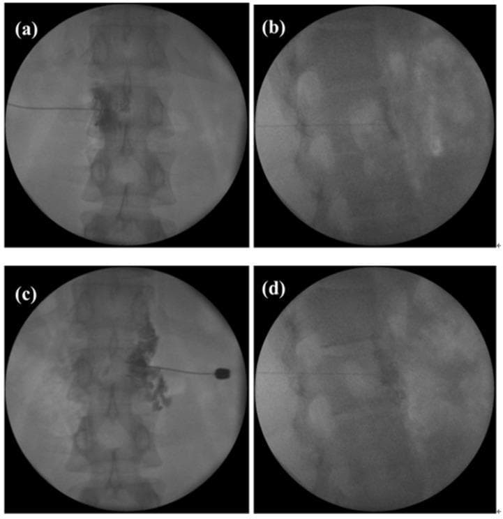 This diagnostic fluoroscopy series illustrates a celiac plexus block (CPB) procedure performed on a patient with resistant hypertension. The image set consists of four panels showcasing a bilateral paravertebral posterior approach. Panels (a) and (c) are anteroposterior (AP) views showing the needle tip positioned adjacent to the L1 vertebral body. In these views, radiopaque contrast material is visualized spreading in a characteristic diffuse, cloud-like pattern prevertebrally, confirming correct needle placement for the injection of botulinum toxin. Panels (b) and (d) provide lateral views, demonstrating the needle's depth and its position relative to the anterior aspect of the vertebral column. The contrast distribution in the lateral views appears as a hazy opacification anterior to the lumbar vertebrae. These images demonstrate a pain management and interventional radiology technique used to target the sympathetic nervous system for the treatment of essential hypertension that is refractory to pharmacological and renal denervation therapies.