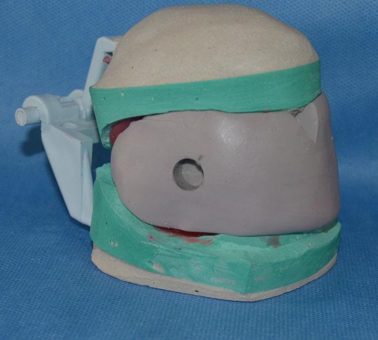 A clinical photograph illustrating a laboratory stage of dental appliance fabrication, specifically a Mandibular Advancement Device (MAD). The image shows a dental stone cast assembly featuring a grey addition silicone putty index. This putty index is positioned over the labial and buccal surfaces of the wax-up to facilitate accurate dewaxing and mold preservation. Key features include carved orientation grooves on the putty surface and a central circular opening on the labial aspect. The assembly is stabilized within green Type II gypsum (dental plaster) compartments, which provide a supporting framework and further orientation guides. The setup is mounted on a white plastic hinge articulator, maintaining the vertical and horizontal relationship between the maxillary and mandibular components. This process is essential for creating a precise mold for heat-cure clear denture base resin during the manufacturing of appliances used in treating obstructive sleep apnea.
