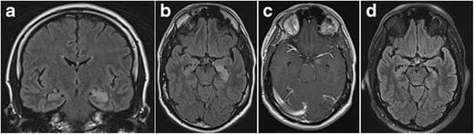 This diagnostic image set showcases a 1.5-T MRI study of Limbic Encephalitis across four sequences. Panel (a) coronal FLAIR and (b) axial FLAIR demonstrate acute-phase findings including significant hyperintense swelling and edema of the left hippocampus. Panel (c) is a contrast-enhanced T1-weighted axial image revealing discrete patchy enhancement within the left amygdala, indicative of blood-brain barrier disruption. Panel (d) displays a follow-up axial FLAIR image obtained six months later, illustrating the progression of the disease. In the chronic stage, the previous hyperintensity has resolved, but is replaced by marked volume loss (atrophy) of the left hippocampus. Notable morphological changes include the disappearance of the normal hippocampal digitations of the hippocampal head and dilation of the adjacent temporal horn of the lateral ventricle. This comparison serves as a clinical teaching tool for recognizing the evolution from acute mesiotemporal inflammation to chronic secondary gliosis and atrophy in limbic encephalitis.