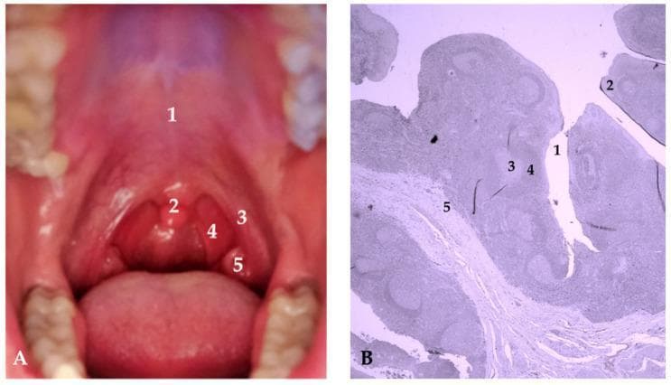 Educational panel illustrating the anatomy and histology of the palatine tonsils. Figure A is a clinical photograph of the oral cavity (oropharynx) showing key landmarks: 1—hard palate; 2—uvula; 3—anterior faucial pillar (palatoglossal arch); 4—posterior faucial pillar (palatopharyngeal arch); and 5—palatine tonsil, located within the tonsillar fossa between the pillars. Figure B is a low-power (200x) light micrograph of a histological section of tonsillar tissue stained with hematoxylin and eosin (H&E). Labeled features include: 1—tonsillar crypt, an invagination of the stratified squamous epithelium; 2—lymphoepithelium; 3—germinal center of a lymphatic follicle, indicating active B-cell proliferation; 4—mantle zone, the peripheral denser layer of the follicle; and 5—interfollicular area containing diffuse lymphoid tissue. The combination of macro-anatomical and micro-anatomical views highlights the tonsils' role as immunocompetent lymphoepithelial organs at the intersection of the upper respiratory and digestive tracts. This material is suitable for medical education regarding ENT anatomy, immunology, and histology.