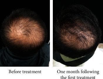 This clinical comparison photograph illustrates the progression of hair growth in a patient with androgenetic alopecia (AGA) before and after therapy. The 'Before treatment' image shows a superior view of the scalp, highlighting significant hair thinning and reduced follicular density primarily at the vertex and mid-scalp regions, resulting in high scalp visibility. The second image, taken 'One month following the first treatment' with Botulinum Toxin Type A (BTA), demonstrates a visible increase in hair density and coverage. The previously exposed patch of scalp is noticeably smaller and less prominent, suggesting improved terminal hair count and follicle activation. This visual evidence supports the clinical application of BTA to improve local blood flow and oxygenation in the scalp to counteract the effects of dihydrotestosterone (DHT) and hypoxia in AGA patients. The comparison serves as an educational tool for evaluating dermatological treatment efficacy for male pattern baldness.