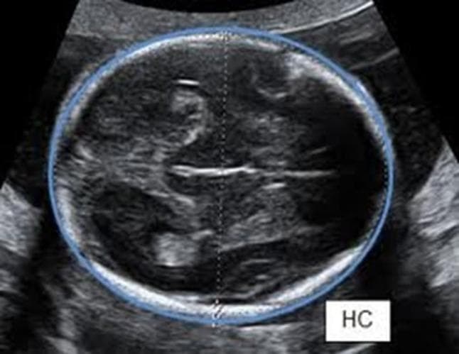 This diagnostic ultrasound image displays an axial cross-section of a fetal head, specifically positioned for biometric assessment. The image demonstrates the standard anatomical plane for measuring Head Circumference (HC) according to ISUOG guidelines. Visible landmarks include the symmetric cerebral hemispheres, the hyperechoic midline falx, and the cavum septum pellucidum. The imaging plane traverses the level of the thalami while specifically excluding the cerebellum to ensure accurate biometry. A blue electronic ellipse is traced around the outer table of the fetal calvaria (skull bone) to calculate the circumference. A vertical dotted line indicates the corresponding biparietal diameter or occipitofrontal diameter axis. The presence of the label 'HC' confirms the educational focus on fetal growth monitoring and obstetrical sonography. This image serves as a clinical example of proper transducer orientation perpendicular to the fetal central axis for standardized prenatal diagnostic measurement.