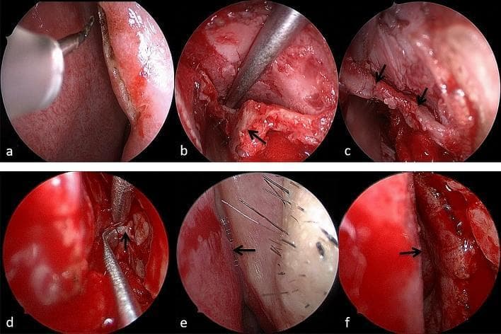 A series of six intranasal endoscopic photographs (a–f) documenting the Endoscopic Endonasal Incisional Reduction (EIIR) of a nasal fracture. (a) Displays the initial 1 cm arc incision at the rim of the piriform aperture using an electric stylet. (b) Shows the exposed displaced fracture of the frontal process of the maxilla (FPM). (c) Demonstrates the reduction of the fracture fragments, with arrows indicating the restored fracture lines. (d) Highlights the intraoperative removal of trapped soft tissue (black arrow) from between bone fragments using surgical forceps. (e) Provides a preoperative endoscopic view of a narrowed internal nasal valve (arrow) caused by the collapsed FPM obstructing the airway. (f) Provides a postoperative view following successful reduction, demonstrating a significantly widened internal nasal valve (arrow) and restored patency. This sequence illustrates the surgical management of traumatic nasal obstruction and aesthetic deformity by addressing displaced maxillary and nasal bone fragments.