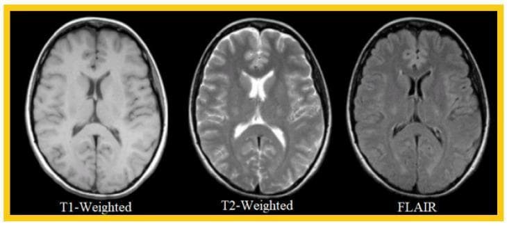 This diagnostic image provides a side-by-side comparison of three common Magnetic Resonance Imaging (MRI) sequences in the axial plane of the human brain: T1-weighted, T2-weighted, and Fluid-Attenuated Inversion Recovery (FLAIR). The comparison illustrates the varying signal intensities of intracranial tissues and fluids across modalities. In the T1-weighted image, cerebrospinal fluid (CSF) is hypointense (dark), while white matter appears hyperintense (bright) relative to gray matter, highlighting excellent anatomical detail and cortical architecture. The T2-weighted sequence shows CSF as hyperintense (bright) and white matter as hypointense, effectively demonstrating fluid-containing spaces like the ventricles and sulci. The FLAIR sequence resembles T2 weighting but utilizes signal suppression to make CSF appear dark, which enhances the visibility of periventricular lesions or cortical pathology that might otherwise be obscured by bright fluid. This comparison is fundamental for medical education in neuroradiology, aiding in the identification of normal anatomy and the selection of appropriate sequences for detecting specific brain pathologies such as tumors or edema.