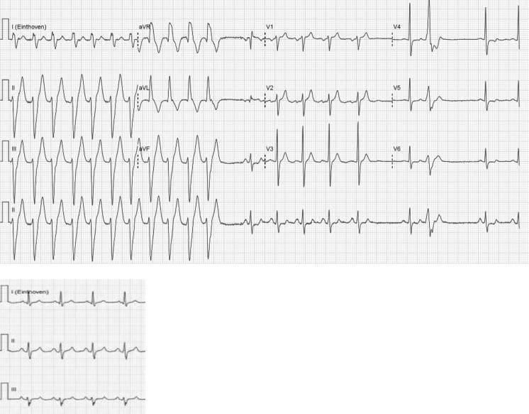 This diagnostic image is a twelve-lead electrocardiogram (ECG) tracing capturing a transition from a wide complex tachycardia to sinus rhythm. The left side of the tracing demonstrates a regular tachycardia with a QRS duration of approximately 146 ms and a rate of 160 bpm. The morphology exhibits a right bundle branch block (RBBB) pattern in V1 and a left axis deviation in the limb leads, suggesting a possible fascicular ventricular tachycardia (VT) or supraventricular tachycardia (SVT) with aberrancy. Following a transition phase, the right side of the tracing shows conversion to a normal sinus rhythm with clearly visible P waves and a significantly narrower QRS complex. The limb leads (I, II, III, aVR, aVL, aVF) and precordial leads (V1-V6) are organized in a standard layout, with a rhythm strip included at the bottom. This ECG illustrates key clinical findings for differentiating ventricular versus supraventricular origins of wide complex tachycardias and demonstrates the effect of therapeutic conversion.