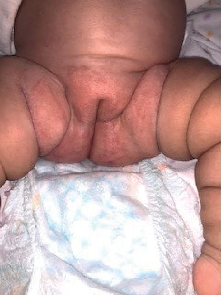 This clinical photograph shows the perineal and inguinal regions of an infant, demonstrating an extensive napkin (diaper) rash. The image reveals diffuse erythema and inflammation across the groin, suprapubic area, and inner thighs. Notable features include the involvement of the skin folds (intertriginous areas), which is characteristic of certain types of primary or secondary diaper dermatitis, such as candidiasis. The affected skin appears slightly macerated and damaged, indicating a breakdown of the epidermal barrier. A disposable diaper is visible at the bottom of the frame, providing clinical context for the distribution of the lesions. This visual represents a common pediatric dermatological condition where the moist, occlusive environment of a diaper leads to skin irritation or secondary infection. The image serves as an educational tool for identifying inflammatory skin changes in the diaper area and assessing the severity of the dermatitis.