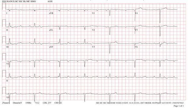 A 12-lead electrocardiogram (ECG) demonstrating a complex arrhythmia characterized by third-degree (complete) heart block. The tracing reveals distinct P waves occurring at a rapid, regular rate indicative of sinus tachycardia, but with total atrioventricular (AV) dissociation. A junctional escape rhythm is present, evidenced by narrow QRS complexes appearing at a significantly slower, regular rate of approximately 42 beats per minute. The precordial leads (V1-V6) show poor R-wave progression. Specific morphology includes upright T-waves in most leads and discernible P waves most prominent in leads II, III, aVF, and V1. The recording is presented on standard grid paper with a 25 mm/s sweep speed and 10 mm/mV sensitivity. This visual exemplifies the clinical presentation of AV nodal or infra-nodal conduction failure where the atrial and ventricular activities are independent of each other.