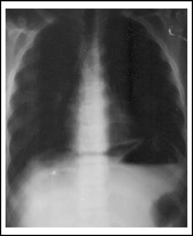 This diagnostic image is an upright plain chest/abdominal X-ray demonstrating a classic sign of pneumoperitoneum. The radiograph clearly shows crescent-shaped radiolucent areas of free air located immediately beneath both the right and left domes of the diaphragm, often referred to as 'free air under the diaphragm'. The diaphragm appears as a thin, curvilinear radio-opaque line separating the pleural cavity from the abdominal cavity. The right hemidiaphragm is elevated by the gas collection, which is positioned between the liver and the diaphragm. The mediastinal shadow, rib cage, and spine are visible, providing anatomical context. This finding is highly indicative of a hollow viscus perforation, such as a perforated peptic ulcer. The image serves as a critical educational example for surgical triage and radiological identification of gastrointestinal emergencies in pediatric or adult populations.
