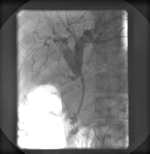 This diagnostic image is an Endoscopic Retrograde Cholangiopancreatography (ERCP) radiograph of the upper right quadrant, focusing on the biliary system. The image demonstrates a fluoroscopic view of the biliary tree opacified with contrast medium. A radiopaque plastic biliary stent is visible within the common bile duct, extending from the hepatic hilum toward the duodenum to bypass a stenotic region. Proximal to the stent, there is significant prestenotic dilatation of the common hepatic duct and the left and right hepatic ducts. Extensive intrahepatic biliary ductal branching is visible, showing signs of moderate dilatation consistent with obstructive jaundice or biliary compression. To the right of the biliary tree, the vertebral bodies and ribs are partially visible. A large radiopaque contrast-filled structure, likely the stomach or duodenum, is observed in the lower-left portion of the frame, indicating the flow of contrast from the stent into the gastrointestinal tract. This visual confirms the successful placement of an endoprosthesis for the management of malignant or benign biliary strictures.
