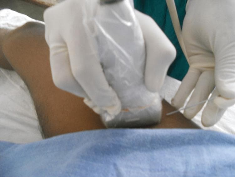 A clinical photograph illustrating the setup for an ultrasound-guided femoral nerve block. The image shows a practitioner's hands, donned in sterile white gloves, performing a procedure on the anterior thigh of a patient. One hand holds a high-frequency linear ultrasound transducer, which is encased in a sterile transparent plastic sleeve to maintain aseptic conditions. The probe is positioned transversely on the skin near the inguinal crease. The other hand is seen introducing a long, thin metallic needle—likely an 18G Quincke spinal needle—using an in-plane or out-of-plane approach relative to the transducer. The patient's limb is partially covered with a blue surgical drape, indicating a sterile field. This visual demonstrates the real-time needle guidance technique used in regional anesthesia to ensure accurate local anesthetic delivery near the femoral nerve while avoiding vascular structures.