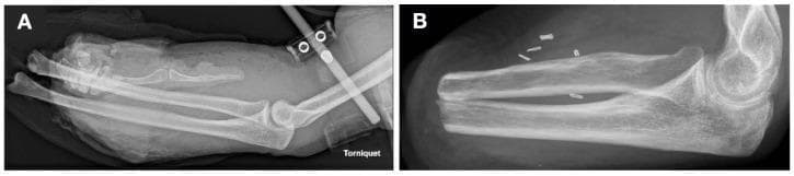 This comparative X-ray radiography series displays a human left forearm in two distinct clinical states: acute trauma and post-surgical amputation. Image A is an anteroposterior view of the forearm following a blast injury, showing significant soft tissue swelling, loss of normal tissue planes, and traumatic disarticulation at the wrist joint. A radiopaque tourniquet is visible proximally. The distal radius and ulna are present but surrounded by diffuse opacity suggesting edema and hemorrhage. Image B shows the same anatomical region five months later following a transradial amputation. The distal portions of the radius and ulna have been surgically resected, exhibiting smooth, rounded cortical margins at the amputation site. Multiple small, radiopaque metallic vessel clips are visible within the distal soft tissues. The elbow joint remains intact in both views. This comparison illustrates the transition from severe musculoskeletal trauma to the stable post-operative state of a residual limb, relevant for orthopedics and physical medicine and rehabilitation (PM&R).