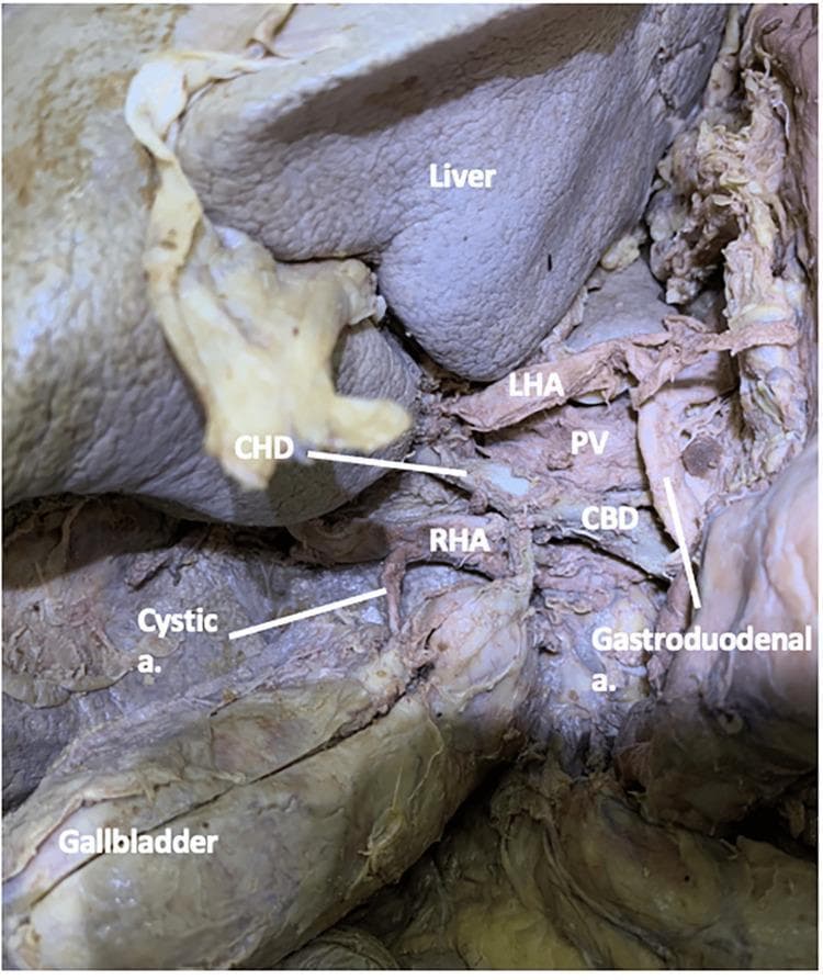 Anatomical dissection of the hepatobiliary region in a human cadaver, demonstrating the spatial relationships within the cystohepatic triangle (Calot's triangle). The image shows the right hepatic artery (RHA) coursing laterally toward the liver, where it gives rise to the cystic artery. The cystic artery is seen branching from the RHA and extending to the gallbladder wall. Key landmarks labeled include the liver (superiorly), gallbladder (inferiorly), common bile duct (CBD), and common hepatic duct (CHD). The portal vein (PV) is visible posterior to the arterial structures, while the left hepatic artery (LHA) and gastroduodenal artery are shown in their respective anatomical positions. This clinical photograph illustrates a standard anatomical configuration where the cystic artery originates from the RHA within the cystic triangle, a critical area for identification during cholecystectomy to avoid iatrogenic injury to the biliary tree or hepatic vasculature.