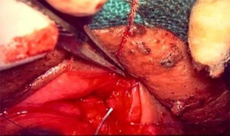 This clinical photograph captures an intraoperative view of an ophthalmic surgical procedure, specifically a Transconjunctival Retractor Plication (TRP) combined with a Lateral Tarsal Strip (LTS) for eyelid malposition correction. The image shows the lower eyelid anatomy with focus on the tarsal plate and retractors. Metallic surgical instruments, including a clamp or needle holder, are visible manipulating the tissue. The surgical field displays the red, vascularized posterior surface of the eyelid and the lower edge of the tarsus. Fine white or translucent sutures are placed through the tissue to secure the reattachment of the eyelid retractors. The surrounding area includes surgical drapes and swabs, highlighting the sterile clinical environment. This visual provides educational insight into oculoplastic techniques used for treating conditions like involutional entropion or ectropion by demonstrating the precise surgical handling and suturing of delicate periocular structures.