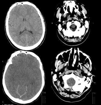 This diagnostic image displays four axial slices of a non-contrast Computed Tomography (CT) scan of the head, focusing on the brain and skull base. The primary finding is diffuse cerebral swelling associated with intracranial hypertension, clinically contexted in this case by cerebral malaria. Key features include generalized effacement of the cerebral sulci and cisterns, indicating significant mass effect from brain edema. The lateral ventricles appear slit-like and compressed. There is a notable loss of normal gray-white matter differentiation throughout the cerebral parenchyma, with a global decrease in tissue density. The lower slices show the posterior fossa and skull base, revealing compression of the subarachnoid spaces and crowding at the foramen magnum. In the most inferior slices, anatomical structures of the facial skeleton, including the nasal cavity, paranasal sinuses, and soft tissues of the neck, are visible with some evidence of overlying soft tissue swelling. This series illustrates the neuroradiological manifestations of acute cerebral edema and the resulting compromise of intracranial CSF spaces.