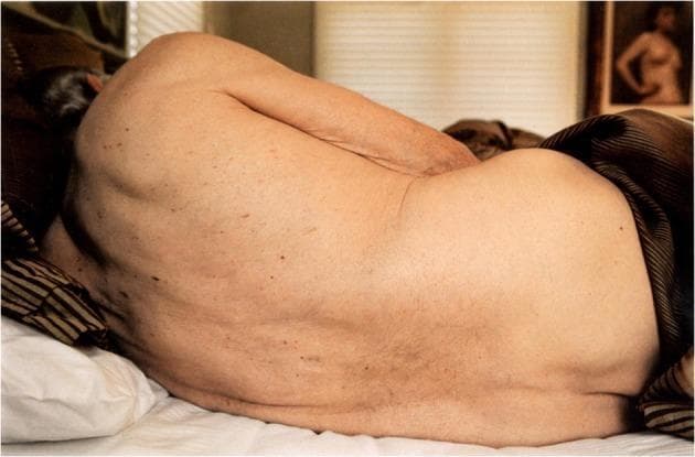 This clinical photograph captures a lateral, slightly curled view of an elderly individual's posterior torso and upper arm while lying in a bed. The image serves as a visual study of geriatric skin and age-related cutaneous findings. Key visible features include multiple benign-appearing skin lesions, such as melanocytic nevi (birthmarks) and potentially seborrheic keratoses, distributed across the back. The skin exhibits signs of chronological aging, including decreased elasticity (laxity), fine wrinkling on the elbow, and visible thinning of the dermis, making superficial bluish veins faintly visible on the arm. The positioning of the body highlights the natural curvature of the spine. The photograph is taken in a domestic setting with natural light, providing high-contrast visibility between the texture of the aging skin and the surrounding smooth bedding. This image is educationally relevant for geriatric medicine and dermatology, illustrating common age-related skin changes and the distribution of common cutaneous lesions in an elderly patient.
