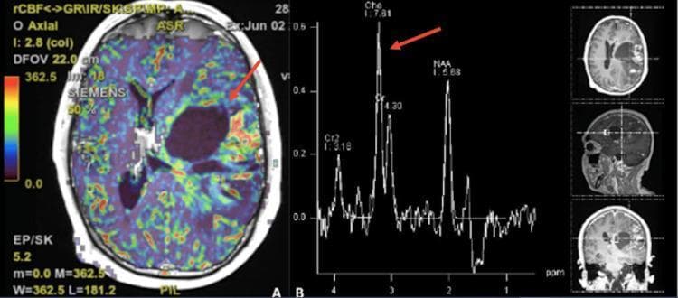 This composite diagnostic image illustrates advanced neuroimaging of an intra-axial brain tumor. Panel A displays a cranial perfusion MRI in the axial plane, specifically a regional cerebral blood flow (rCBF) map. An arrow points to the tumor's periphery, which exhibits hypervasculature characterized by high-intensity red and yellow hues on the color-coded scale, indicating significantly increased perfusion compared to the surrounding blue-toned parenchyma. Panel B presents a Magnetic Resonance Spectroscopy (MRS) plot representing the central tumor area. The spectrum shows a pathognomonic 'inversion' of the metabolite curve, where the Choline (Cho) peak is significantly elevated relative to the N-acetylaspartate (NAA) and Creatine (Cr) peaks. This Cho/NAA ratio elevation is a hallmark of high cellular turnover and malignancy. Accompanying the spectroscopy plot are three anatomical reference scouts (axial, sagittal, and coronal) demonstrating the tumor's localization in the mesial temporal and insular regions. These findings are characteristic of high-grade gliomas or hypervascular intracranial lesions.
