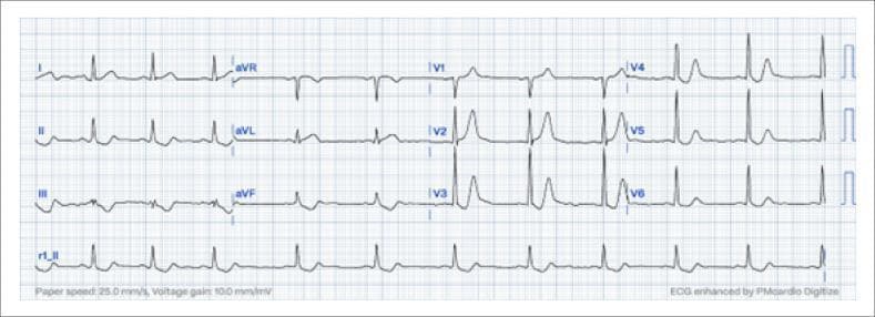 This diagnostic image is a 12-lead electrocardiogram (ECG) recorded at 25 mm/s and 10 mm/mV, demonstrating the De Winter pattern, a critical sign of acute Occlusion Myocardial Infarction (OMI) involving the Left Anterior Descending (LAD) artery. The tracing highlights characteristic precordial lead findings from V1 through V6. Key visual features include a significant ST-segment depression at the J-point (at least 1 mm), which immediately transitions into a tall, symmetrical, positive hyperacute T wave with an upsloping ST segment. Additionally, slight ST-segment elevation is visible in lead aVR, which often accompanies this pattern. This ECG morphology is a high-specificity equivalent to an ST-Elevation Myocardial Infarction (STEMI), signifying acute proximal LAD occlusion despite the lack of classic ST-elevation in the precordial leads. This educational material is intended for cardiology and emergency medicine training to improve the rapid identification of subtle ischemic signs that necessitate urgent reperfusion therapy.