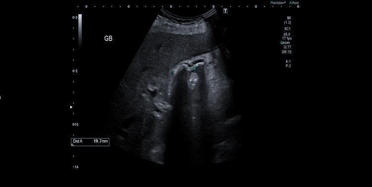 This abdominal ultrasound image depicts the gallbladder in a transverse or longitudinal section. The primary clinical finding is cholelithiasis, characterized by at least two highly echogenic structures within the gallbladder lumen. These structures exhibit posterior acoustic shadowing, a hallmark diagnostic feature of gallstones. A measurement caliper labeled 'Dist A' indicates one stone measures approximately 19.7 mm. The gallbladder wall appears thin and regular, with no evidence of wall thickening, pericholecystic fluid, or sonographic Murphy's sign, findings which help rule out acute cholecystitis at the time of imaging. The surrounding hepatic parenchyma shows normal, homogeneous echogenicity. The image is annotated with 'GB' to identify the gallbladder and includes technical parameters such as depth (14 cm) and mechanical index (1.3). This imaging is consistent with symptomatic biliary colic in a patient with known cholelithiasis.