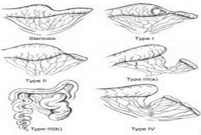 This medical illustration depicts the Gross-LOUW classification system for intestinal atresia, a congenital malformation of the small bowel. The diagram presents six distinct morphological types: 'Stenosis' shows a narrowing of the bowel without loss of continuity. 'Type I' depicts an internal diaphragm or web with intact bowel wall and mesentery. 'Type II' illustrates two blind ends connected by a fibrous cord. 'Type III(a)' shows a complete separation of bowel ends with a V-shaped mesenteric defect. 'Type III(b)' (Apple Peel/Christmas Tree atresia) demonstrates a proximal atresia with the distal bowel spiraling around a single perfusing artery due to an extensive mesenteric vascular insult. 'Type IV' indicates multiple 'string-of-sausage' atresias. Each panel highlights the relationship between the proximal dilated segment, the distal collapsed segment, and the integrity of the associated mesenteric blood supply, serving as a critical diagnostic guide for pediatric surgical pathology.