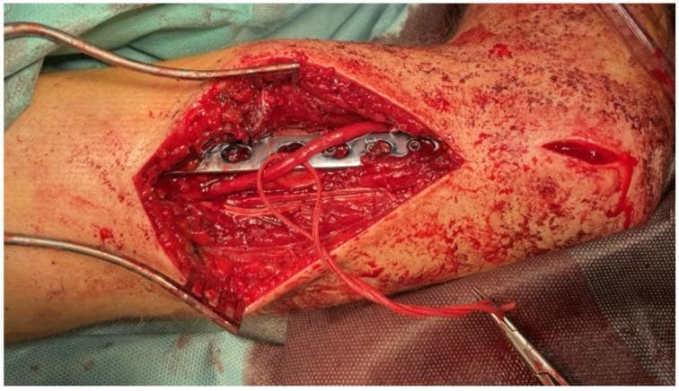 This intraoperative clinical photograph captures a surgical procedure for open reduction and internal fixation (ORIF) of a humeral shaft fracture. The surgical field reveals a long, metallic internal fixation plate with approximately 8-10 visible screw holes positioned directly on the bone. The radial nerve is prominently exposed and mobilized to prevent entrapment or injury during the fixation; it appears as a continuous, reddish-pink tubular structure. A red vessel loop or suture is used to gently retract and identify the nerve, which is held by a surgical instrument. Self-retaining retractors are positioned to maintain the surgical window through the muscle and soft tissue layers. The image demonstrates the critical relationship between orthopedic hardware and adjacent neurovascular bundles in the distal third of the humerus. This visual is significant for illustrating nerve exploration techniques used to manage radial nerve palsy associated with humeral fractures. Key educational concepts include surgical anatomy, fracture management, and peripheral nerve preservation during orthopedic trauma surgery.