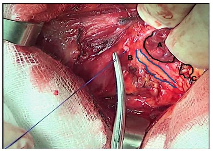 This clinical photograph displays an intraoperative view of a thyroidectomy during a recurrent laryngeal nerve (RLN) dissection, captured under 2.5x optical magnification. The surgical field highlights critical anatomical structures labeled as follows: (A) the reddish-brown, lobulated thyroid gland parenchyma; (B) the right-sided recurrent laryngeal nerve, identified as a slender, yellowish-white string-like structure outlined in blue; and (C) the inferior parathyroid gland, appearing as a small, beige-colored nodule in close proximity to the thyroid and nerve. Surgical instruments including a metallic hemostat and a blue suture thread are visible, facilitating tissue retraction and identification. White surgical gauze and metallic retractors define the periphery of the operative site. This image serves as an educational tool for endocrine surgery, illustrating the precise identification and preservation of the RLN and parathyroid glands to prevent postoperative complications such as vocal cord paralysis and hypocalcemia.