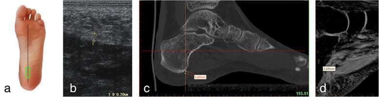 This multicomponent educational figure demonstrates a comparative multimodal imaging approach for measuring the plantar fascia thickness at its calcaneal origin. Panel A is an anatomical diagram of the plantar foot surface showing a longitudinal probe placement (green rectangle) over the medial tubercle of the calcaneus. Panel B is a longitudinal musculoskeletal ultrasound image (sonogram) displaying the hyperechoic, fibrillar plantar fascia with a caliper measurement of 0.28 cm. Panel C shows a sagittal reconstruction CT scan in a bone window, highlighting the skeletal anatomy of the calcaneus and midfoot with a software-based measurement of the plantar fascia origin at 2.69 mm. Panel D presents a sagittal T1-weighted or proton-density MRI sequence, providing superior soft tissue contrast of the plantar aponeurosis and heel pad, also displaying a measurement of 2.69 mm. This comparison illustrates the consistency between imaging modalities (ultrasound, CT, and MRI) for the clinical assessment of plantar fasciitis and anatomical morphometry.