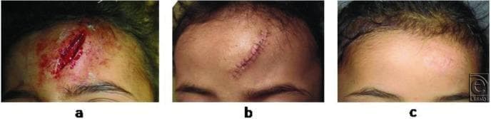 This clinical photograph sequence documents the progression of facial wound healing in a pediatric patient across three stages. Panel (a) shows an acute, deep vertical laceration on the forehead approximately 4 cm in length. The wound exhibits disrupted skin edges, visible subcutaneous tissue, and active bleeding with surrounding erythema. Panel (b) illustrates the same region 6 days post-repair using autologous hair sutures. The wound edges are well-approximated with visible simple interrupted sutures, and there is localized postoperative inflammation and crusting along the incision line. Panel (c) displays the outcomes at 3 months post-procedure, demonstrating a matured, fine-line scar. The scar is flat and hypopigmented, showing excellent integration with the surrounding skin texture and a complete absence of cross-hatch suture marks ('railroad tracking'). This series serves as an educational comparison of surgical repair outcomes and long-term cicatrization in aesthetic facial regions.