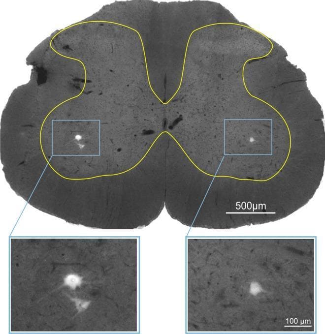 This diagnostic image shows a cross-sectional view of the L5 spinal cord segment, typical for neuroanatomical research. The section displays the characteristic butterfly-shaped central grey matter, demarcated by a yellow border, surrounded by peripheral white matter. The image demonstrates retrograde tracing of alpha-motoneurons (α-MNs) using True Blue fluorescence tracer, which was injected into the lateral gastrocnemius (LG) muscle. Two blue rectangular frames in the ventral horns highlight the bilateral distribution of labeled motoneurons. Below the main section, magnified inset views (100 µm scale) reveal the detailed morphology of these motoneurons, characterized by bright, fluorescent somata against a dark background, showing irregular polygonal shapes and emerging cellular processes. These α-motoneurons are essential components of the lower motor neuron system, and their visualization allows for the study of synaptic connectivity, such as glutamatergic VGLUT1 and cholinergic VAChT terminal density. The main section includes a 500 µm scale bar for anatomical orientation. This material is designed for advanced neuroanatomy and physiology education, focusing on spinal cord circuitry and motor unit innervation.
