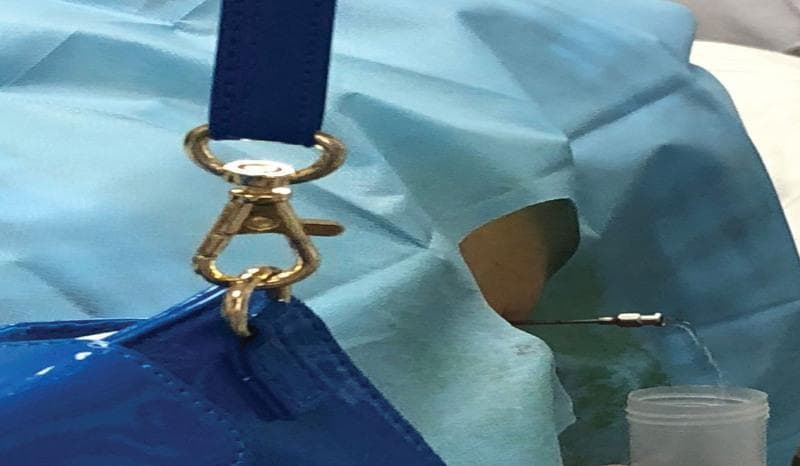 This clinical procedural photograph illustrates a subarachnoid puncture, commonly referred to as a lumbar puncture, being performed for cerebrospinal fluid (CSF) collection or drainage. The image shows a spinal needle inserted into the lumbar region of a patient, specifically at the L2-L3 interspace. The procedural site is prepared with sterile blue surgical drapes. A key clinical finding is the visualization of clear, colorless fluid (CSF) dripping from the hub of the spinal needle into a sterile collection container, confirming successful entry into the subarachnoid space. This visual evidence of 'free-flow' is critical for diagnostic sampling and therapeutic pressure management. The photograph demonstrates proper aseptic technique and the lateral approach for accessing the lumbar cistern. It serves as an educational tool for medical students and clinicians to recognize the appearance of CSF during neurosurgical or neurological procedures, highlighting the correct anatomical positioning and procedural outcomes in a clinical setting.