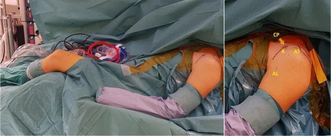Clinical photograph showing a patient in the beach chair position prepared for left shoulder arthroscopy. The surgical site is draped with sterile blue covers and yellow antimicrobial incise drapes. A close-up view identifies key anatomical landmarks and planned surgical portal sites marked on the skin in yellow. The coracoid process (CP) is indicated by an arrow. The instrumentation portals are labeled as follows: the anterosuperior portal (AS) located superior to the coracoid; the anterior portal (A) positioned slightly inferior and medial; and the anterolateral portal (AL) located on the lateral aspect of the shoulder. The ipsilateral knee is also visible and draped, prepared for a semitendinosus (ST) graft harvest. This image demonstrates the standard preoperative setup and surface anatomy necessary for complex shoulder stabilization procedures, such as a subscapular sling technique for anterior shoulder instability.