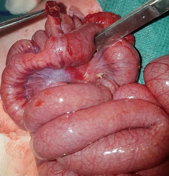 Clinical intraoperative photograph during an exploratory laparotomy, demonstrating a Meckel's diverticulum causing a small bowel obstruction. The image shows several loops of markedly dilated, erythematous small intestine with prominent surface vascularization and subserosal congestion, indicative of acute obstruction and inflammatory changes. A surgical clamp is positioned at the superior aspect of the field, grasping the tip of the Meckel's diverticulum, which appears dark red and engorged. A second surgical instrument (forceps or retractor) is visible to the right, manipulating the mesentery and adjacent bowel wall. The serosal surface of the bowel appears taut and shiny, suggesting significant intraluminal distension and mural edema. This case illustrates a common pediatric surgical emergency where a congenital remnant leads to mechanical volvulus or internal herniation. This image is relevant for surgical training in identifying congenital gastrointestinal anomalies and the physical manifestations of neonatal intestinal obstruction.