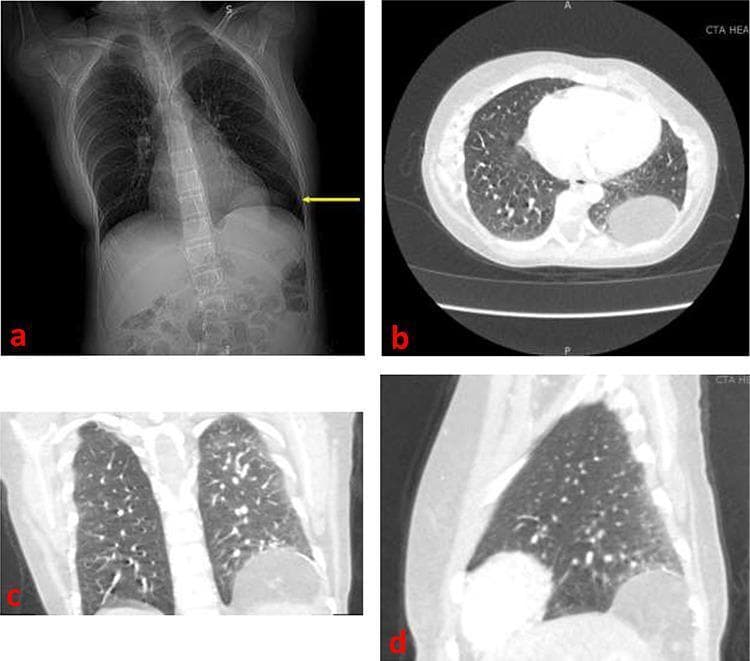 This composite of diagnostic images illustrates a Bochdalek diaphragmatic hernia in the left hemithorax through multiple modalities. (a) A frontal chest radiograph displays an obscure soft tissue opacity above the left hemidiaphragm (indicated by a yellow arrow), suggesting a protrusion into the thoracic cavity. (b, c, d) Contrast-enhanced Computed Tomography (CT) images in axial, coronal, and sagittal planes provide definitive characterization. The CT images reveal a well-defined, approximately 6 x 6 cm mass of retroperitoneal fat and omental tissue herniating through a defect in the posterolateral aspect of the left diaphragm. The axial view shows the rounded protrusion displacing lung parenchyma, while the coronal and sagittal reformats highlight the superior migration of abdominal contents through the diaphragmatic hiatus. Contrast enhancement aids in differentiating the low-density adipose tissue within the hernia from the surrounding pleura, chest wall, and vascular structures, demonstrating the clinical utility of cross-sectional imaging for surgical planning in diaphragmatic defects.