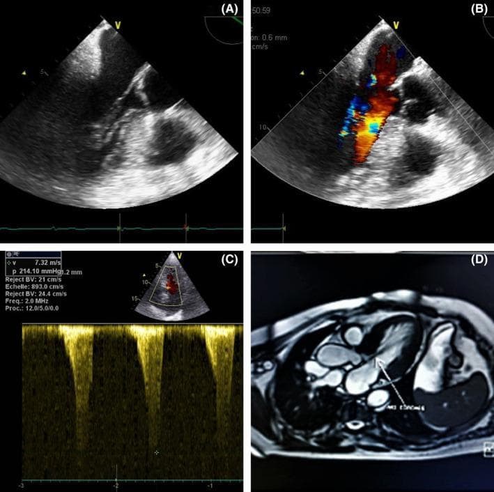 This composite figure illustrates a case of Hypertrophic Obstructive Cardiomyopathy (HOCM) using multimodal imaging. Panel A shows a 2D transthoracic echocardiogram in the apical view, highlighting asymmetric septal hypertrophy (20mm thickness) and significant narrowing of the left ventricular outflow tract (LVOT). Two anomalous subvalvular chordae are visible attached to the interventricular septum and mitro-aortic trigone. Panel B is a Color Doppler image demonstrating turbulent, high-velocity flow acceleration (aliasing/mosaic pattern) across the LVOT and concomitant moderate mitral regurgitation. Panel C displays a Continuous-Wave (CW) Doppler tracing showing a peak velocity of 7.32 m/s and a peak pressure gradient of approximately 210 mmHg, characterized by a classic late-peaking 'dagger-shaped' waveform pathognomonic for dynamic LVOT obstruction. Panel D provides a cardiac MRI (CMR) correlation, confirming the abnormal insertion of chordae tendineae and the dominance of basal septal hypertrophy in causing the obstruction. This collection is used to teach the diagnostic features of dynamic outflow tract obstruction and the role of adjunctive imaging in characterizing subvalvular anatomy.