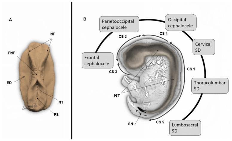 This medical illustration depicts the embryological development of the human neural tube and the multisite closure model. Panel A presents a superior view of the embryonic disk (ED) during the 3rd postconceptional week. Key features include the neural folds (NF) and the initial point of fusion (FNF) where the folds begin to merge to form the neural tube (NT). The primitive streak (PS) is visible at the caudal end, establishing the embryonic axis. Panel B shows a mid-sagittal section of an embryo, illustrating the five distinct closure sites (CS 1–5). The diagram maps specific neural tube defects (NTDs) to failures at these sites: frontal cephalocele (CS 3), parietooccipital cephalocele (CS 2), occipital cephalocele (CS 4), cervical spinal dysraphism (SD) (CS 1), and lumbosacral SD (CS 5). The process of secondary neurulation (SN) is indicated at the distal caudal end. This educational content demonstrates the critical stages of primary neurulation and the clinical correlation between embryonic closure sites and congenital malformations of the central nervous system.