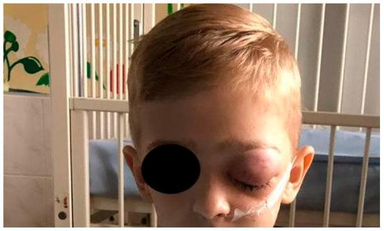 A clinical photograph of a 7-year-old pediatric patient demonstrating severe unilateral facial swelling and erythema on the left side, consistent with orbital phlegmon or orbital cellulitis. The visual highlights marked edema of the left upper and lower eyelids, resulting in significant narrowing of the palpebral fissure. The swelling extends to the periorbital and malar regions. A medical adhesive and a tube, likely a nasogastric tube or oxygen cannula, are visible at the nostril, indicating inpatient management. The background suggests a hospital setting with a clinical bed or crib. This image illustrates the external manifestations of a serious odontogenic infection that has spread to the upper face, emphasizing the need for urgent clinical evaluation to prevent complications such as vision loss or intracranial extension. The educational focus is on identifying acute periorbital inflammatory signs in children.