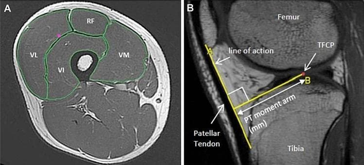 This composite educational material consists of two T1-weighted magnetic resonance (MR) images demonstrating musculoskeletal anatomy and biomechanical measurements of the lower limb. Image A is an axial MR cross-section of the mid-thigh, featuring manually segmented green outlines of the four quadriceps femoris muscles: the Rectus Femoris (RF) located anteriorly, the Vastus Lateralis (VL) laterally, the Vastus Medialis (VM) medially, and the Vastus Intermedius (VI) situated centrally and deep, surrounding the femur. This view is utilized for calculating anatomical cross-sectional area (ACSA) and muscle volume. Image B is a sagittal MR image of the knee joint illustrating the biomechanical concept of the patellar tendon moment arm (PTMA). The PTMA is visually defined as the perpendicular distance (white line) between the patellar tendon's line of action (yellow line A) and the tibiofemoral contact point (TFCP, marked by a red dot at point B). This measurement is critical for assessing the mechanical advantage of the quadriceps during knee extension. Both images serve as primary diagnostic and research tools in sports medicine and orthopedics for evaluating muscle architecture and joint mechanics.