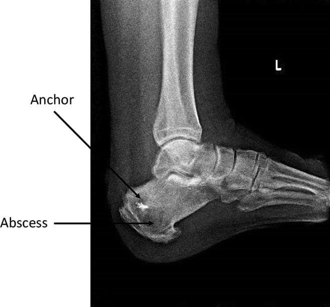 A lateral preoperative X-ray of the left ankle and foot demonstrating chronic osteomyelitis of the calcaneus. The diagnostic image shows a large, radiolucent, intraosseous cystic lesion at the calcaneal tuberosity, labeled as an abscess. This 6x5 cm lesion is located distal and ventral to a previously placed metallic surgical anchor, which appears as a small, high-density radio-opaque structure. The abscess exhibits defined but irregular borders against the surrounding trabecular bone, which shows signs of diffuse bone marrow edema and reactive changes. Visible anatomical structures include the calcaneus, talus, and midfoot bones. This radiograph serves as a key educational example of a Brodie's abscess or chronic calcaneal osteomyelitis following orthopedic surgery, illustrating the use of imaging for preoperative planning and localization of infectious collections within the foot and ankle.