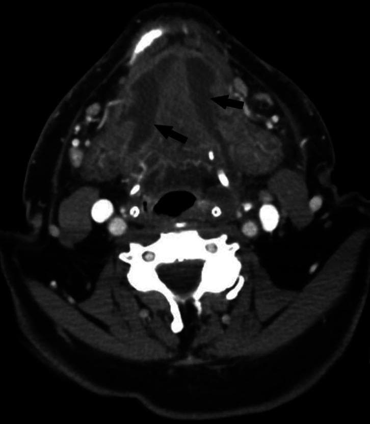 This diagnostic image is an axial contrast-enhanced CT scan of the submandibular and floor-of-mouth region. The image demonstrates a characteristic presentation of Ludwig's angina, an aggressive cellulitis of the submandibular space. Significant pathology includes bilateral hypodense areas within the floor of the mouth (indicated by black arrows), representing the formation of bilateral abscesses. These collections are associated with diffuse soft tissue swelling and a noticeable mass effect on the surrounding structures. Key anatomical landmarks visible include the mandible, the cervical spine, and the oropharyngeal airway, the latter of which shows significant narrowing (stenosis) due to the posterior displacement and swelling of the tongue and sublingual tissues. The pathology originates from the mandibular molar region, highlighting the odontogenic nature of the infection. This image is used in medical education to illustrate life-threatening airway compromise and the diagnostic imaging findings associated with deep neck space infections and maxillofacial emergencies.