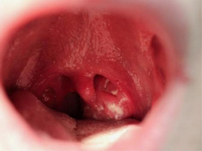 This clinical photograph provides an intraoral view of the oropharynx, demonstrating classic signs of exudative tonsillitis and pharyngitis. The palatine tonsils are bilaterally enlarged (tonsillar hypertrophy) and erythematous, featuring prominent white-to-yellowish confluent exudates on the mucosal surface. The surrounding tissues, including the posterior pharyngeal wall and soft palate, exhibit significant hyperemia. Notably, the uvula is markedly edematous and erythematous (uvulitis). These visual findings are highly characteristic of infectious mononucleosis caused by the Epstein-Barr virus (EBV), particularly in young adult populations. The image serves as an educational reference for distinguishing between simple viral pharyngitis and more severe exudative presentations that involve widespread oropharyngeal inflammation, lymphoid hyperplasia, and constitutional symptoms like cervical lymphadenopathy and fatigue.