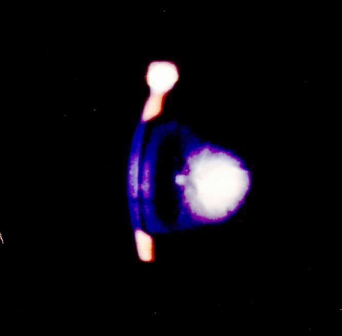 This clinical photograph displays a level 4 cataract, captured via slit-lamp biomicroscopy. The image demonstrates advanced lenticular opacification characterized by a central, highly dense white core exhibiting complete light reflection and opalescence. This central opacity is surrounded by a diffuse, purple-blue opacified region that involves the entire lens structure. The high-grade density is indicative of advanced protein aggregation and light scattering within the lens cortex and nucleus. This visual representation serves as a classic educational example of radiation-induced cataractogenesis, where a rapid progression from minimal opacity (grade 1.5+) to total opacification (grade 4.0) occurs within a clinical observation period. The dark, featureless background contrasts with the bright, reflective cataractous lens, highlighting the loss of transparency. This material is significant for ophthalmology students and residents studying the grading scales of cataracts and the ocular manifestations of ionizing radiation exposure.