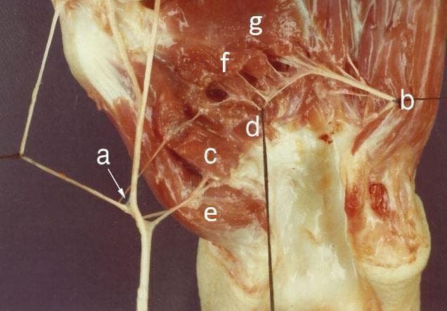 An anatomical dissection photograph of the human thenar region and palm, illustrating the intrinsic muscles of the hand and their dual nerve supply. The image features a detailed view of the muscular architecture including the abductor pollicis brevis, and the superficial and deep heads of the flexor pollicis brevis (FPB). A key educational focus is the demonstration of double innervation: a branch of the median nerve is shown supplying the abductor pollicis brevis and the superficial head of the FPB, while the deep branch of the ulnar nerve is visualized providing motor innervation to the deep head of the FPB and the adductor pollicis muscle. Both the oblique and transverse heads of the adductor pollicis are clearly demarcated. The dissection highlights the critical spatial relationships between the recurrent branch of the median nerve and the deep branch of the ulnar nerve within the palm, serving as an important clinical reference for hand surgery, nerve entrapment syndromes, and neuromuscular assessment.