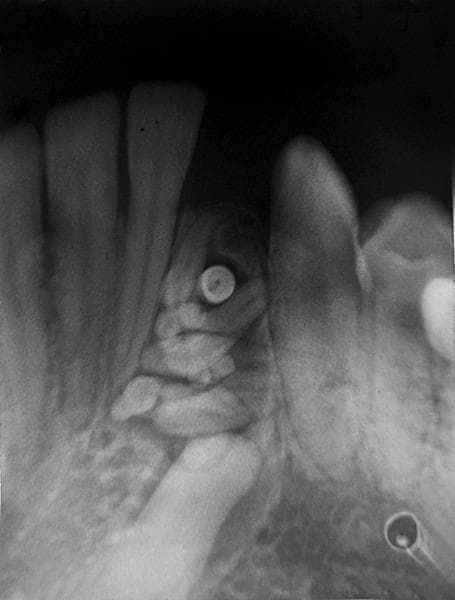 This diagnostic intraoral radiograph illustrates a classic presentation of a compound odontoma in the human jaw. The image shows a well-circumscribed, mixed radiopaque and radiolucent lesion situated between the roots of adjacent erupted teeth. The lesion is characterized by a cluster of multiple small, tooth-like structures (denticles) of varying shapes and sizes, exhibiting high density consistent with enamel and dentin. A prominent, rounded, highly radiopaque mass is visible within the central portion of the cluster. The surrounding periapical bone displays normal trabeculation with slight reactive sclerosis at the periphery of the lesion. There is evidence of localized tooth displacement and widening of the follicular space around the mass. This visual finding is pathognomonic for a compound odontoma, an odontogenic hamartoma, and is a key educational example for dental and oral surgery residents studying benign odontogenic tumors and developmental dental anomalies.