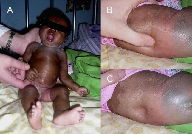 This set of clinical photographs illustrates a pediatric patient presenting with severe generalized edema (anasarca). Panel A displays a frontal view of an infant with significant swelling affecting the face, periorbital region, neck, trunk, and extremities. The skin appears tense, glossy, and exhibits areas of pallor and hyperpigmentation. Panels B and C demonstrate the physical examination for pitting edema on the patient's back. Panel B shows a clinician's thumb applying pressure to the edematous tissue, while Panel C reveals a deep, persistent indentation (pitting) remaining after the pressure is released. This clinical presentation is associated with systemic fluid overload or severe hypoalbuminemia, documented here in the context of an atypical parasitic infection. The images serve as a teaching tool for identifying the visual signs of gross edema and the technique for eliciting and documenting pitting in soft tissues.