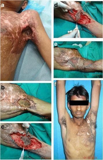 A clinical composite image series documenting the surgical management of a Type II left axillary post-burn contracture in a 29-year-old male. (a) Preoperative view showing severe anterior chest wall scarring and limited shoulder abduction (45°). (b) Intraoperative markings for a zig-zag modified propeller flap based on a central subcutaneous pedicle. (c, d) Contracture release and elevation of the islanded flap, followed by a 90-degree 'propeller' rotation to straddle the anterior and posterior axillary contracting bands. (e) Immediate postoperative view illustrating the flap inset with primary closure of partial donor sites and split skin grafting (SSG) for remaining defects. (f) Three-year follow-up demonstrating restoration of full range of motion (overhead abduction), improved skin contour, and aesthetic outcome. The sequence illustrates the utility of subcutaneous pedicled propeller flaps in reconstructing complex joint contractures by interposing healthy skin into the scar field to prevent recurrence.
