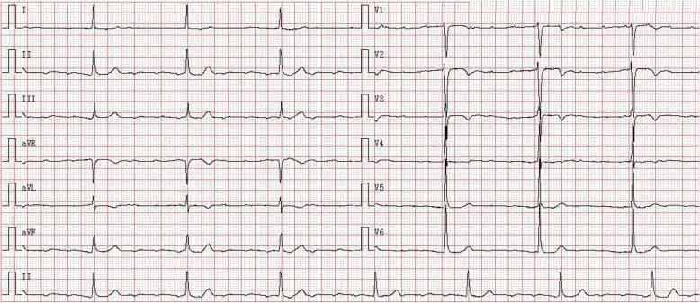 A 12-lead baseline electrocardiogram (ECG) recorded at 25 mm/s and 10 mm/mV, demonstrating complex cardiac conduction abnormalities. The tracing shows a rapid, irregular atrial arrhythmia, likely atrial fibrillation or high-frequency atrial tachycardia, with an atrial rate of approximately 180 beats per minute. Distinct P waves are absent, replaced by fibrillatory waves visible in the baseline, particularly in lead V1. Concurrent with this is a complete (third-degree) atrioventricular (AV) block, evidenced by the total dissociation between atrial activity and ventricular response. The ventricles are driven by a junctional escape rhythm, resulting in a slow, regular ventricular rate of approximately 43 beats per minute. The QRS complexes are relatively narrow (approximately 90 ms), consistent with a supra-Hisian escape focus. The tracing includes limb leads (I, II, III, aVR, aVL, aVF) and precordial leads (V1-V6), with a continuous lead II rhythm strip at the bottom. This visual record is characteristic of advanced conduction system disease, often associated with LMNA-related cardiomyopathies or other structural heart diseases.